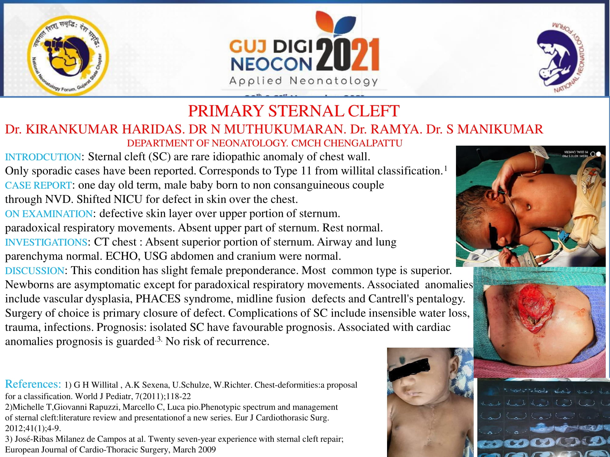 Primary sternal cleft